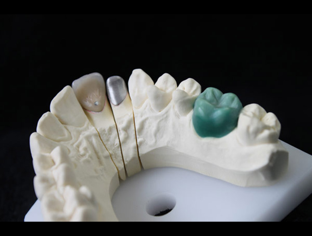Couronnes dentaires en porcelaine