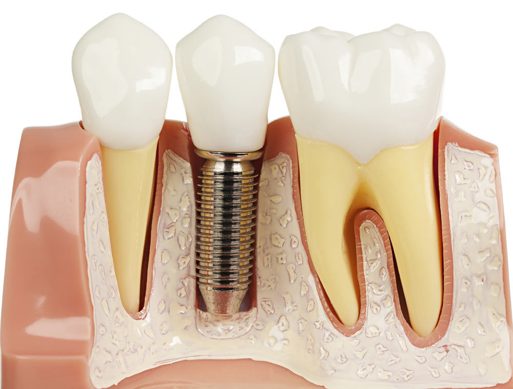 Modèle d’implant dentaire